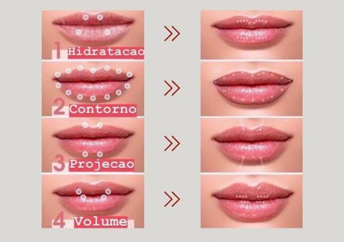 Bonita Derme - Estética Avançada - Preenchimento Labial
