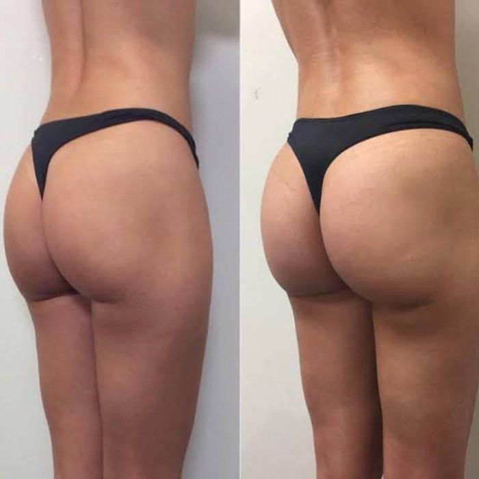 Clínica Ego Estetica Avançada - Estetica e Saúde - Harmonização glútea - Bio Gluteo