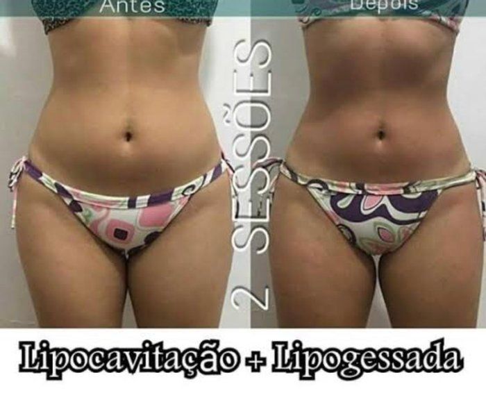 Skin Revolution  - Estética Facial e Corporal - lipocavitaçao