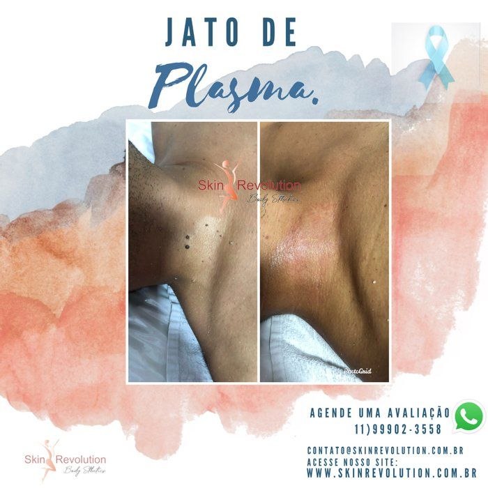 Skin Revolution  - Estética Facial e Corporal - Jato de plasma 