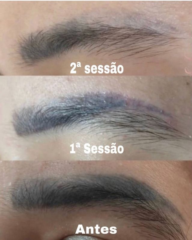 Skin Revolution  - Estética Facial e Corporal - Despigmentaçao com Jato de plasma