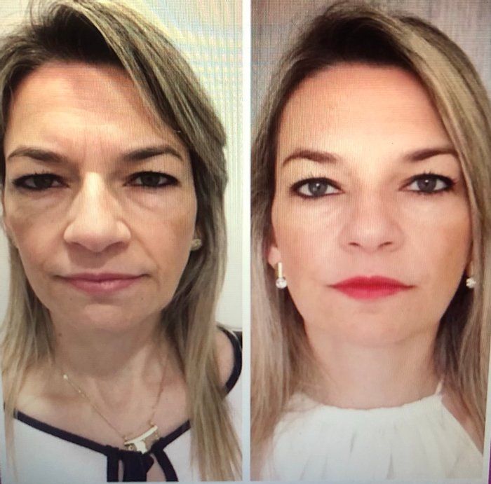 Skin Revolution  - Estética Facial e Corporal - Bioestimuladores colageno