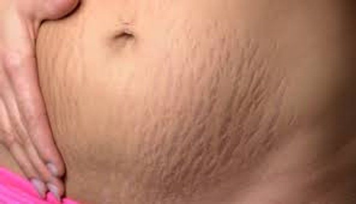 Bela Rosa Centro de Estética - beleza & estética - Tratamento para Estrias