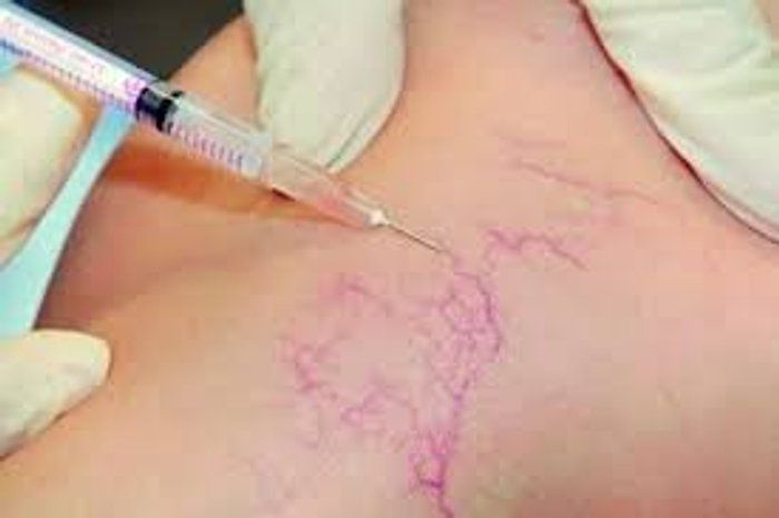 Bela Rosa Centro de Estética - beleza & estética - Aplicação de PEIM ( Microvasos)