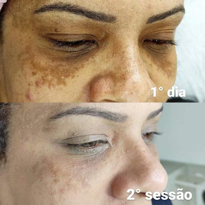 Rayssa Basilio - Estética avançada - Melasma