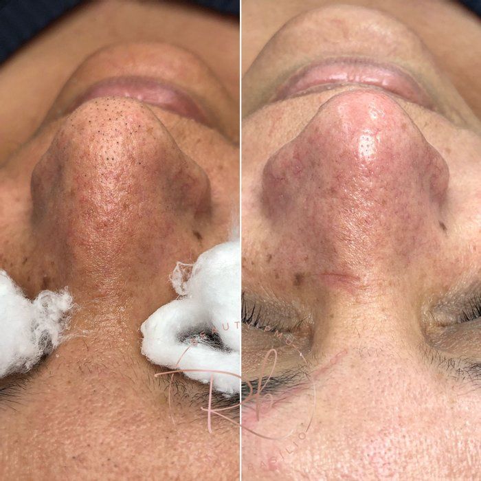 Rayssa Basilio - Estética avançada - Limpeza de pele