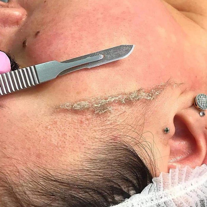 Rayssa Basilio - Estética avançada - Dermaplaning