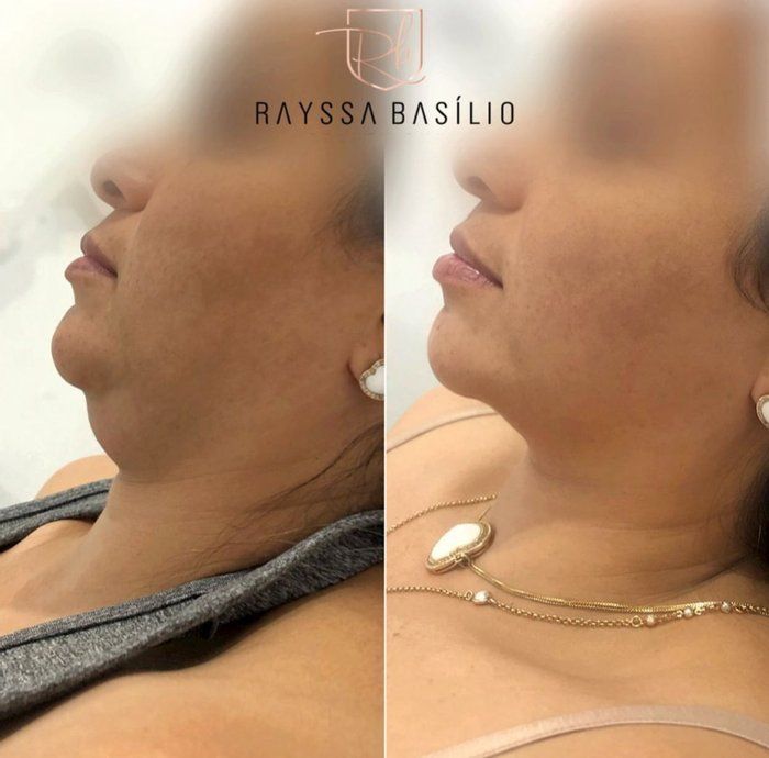 Rayssa Basilio - Estética avançada - Lipo papada