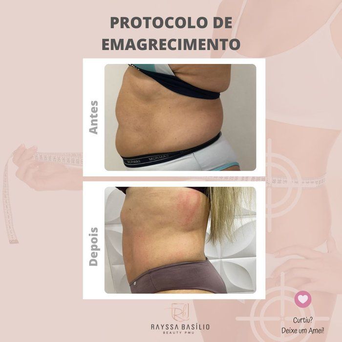 Rayssa Basilio - Estética avançada - Lipo enzimática corporal