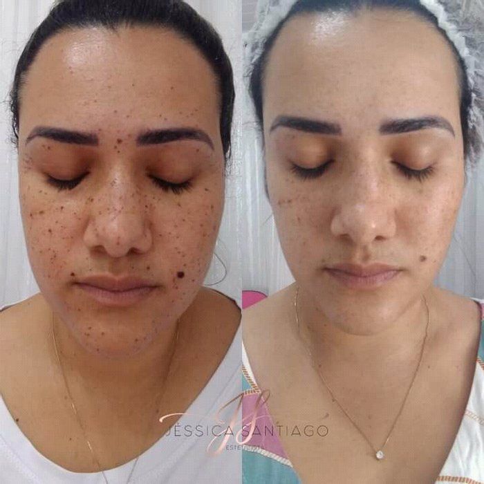 Nilvania Silva - Estética - Saúde - Beleza - Tratamento com jato de plasma 