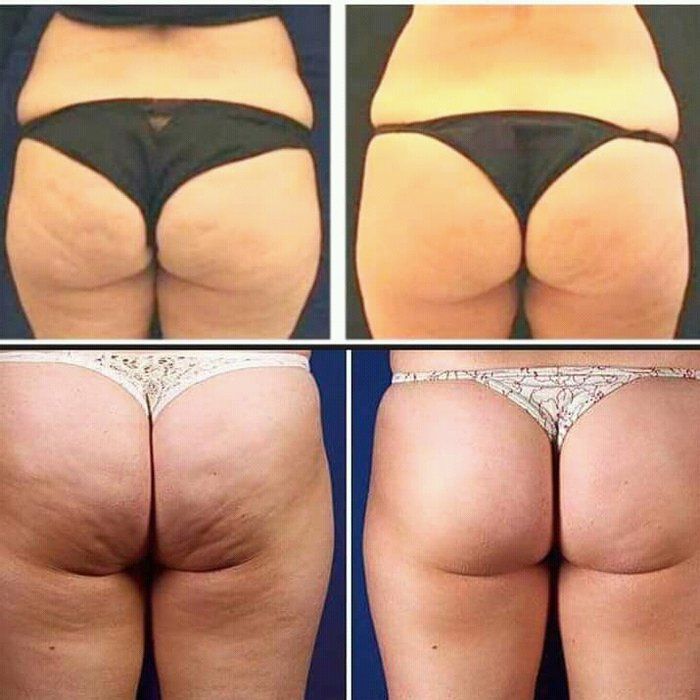 Nilvania Silva - Estética - Saúde - Beleza - massagem madeladora redutora