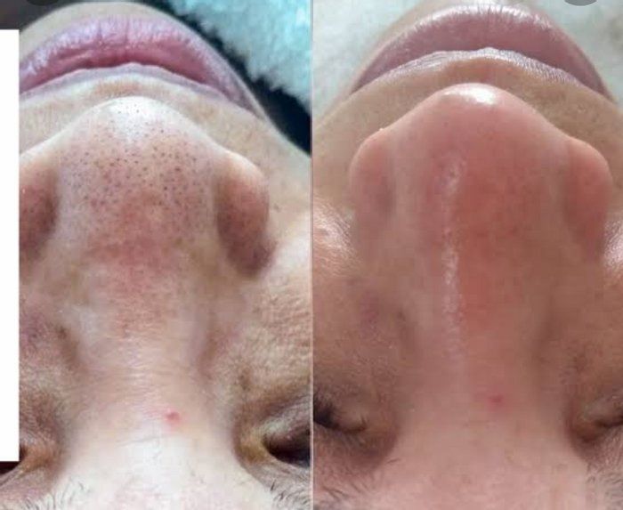 Nilvania Silva - Estética - Saúde - Beleza - limpeza de pele profunda com extração