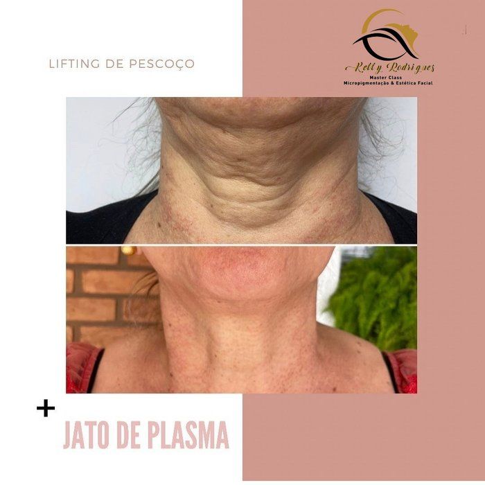 KG COMPLEXO BEAUTY - CLINIC | EYELASHES & PMU | ACADEMY - Jato de Plasma - Protocolo Flacidez