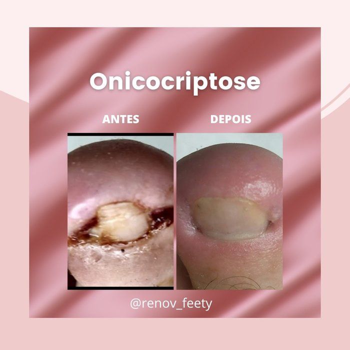 Renov Feety - Podologia - protocolo onicriptose