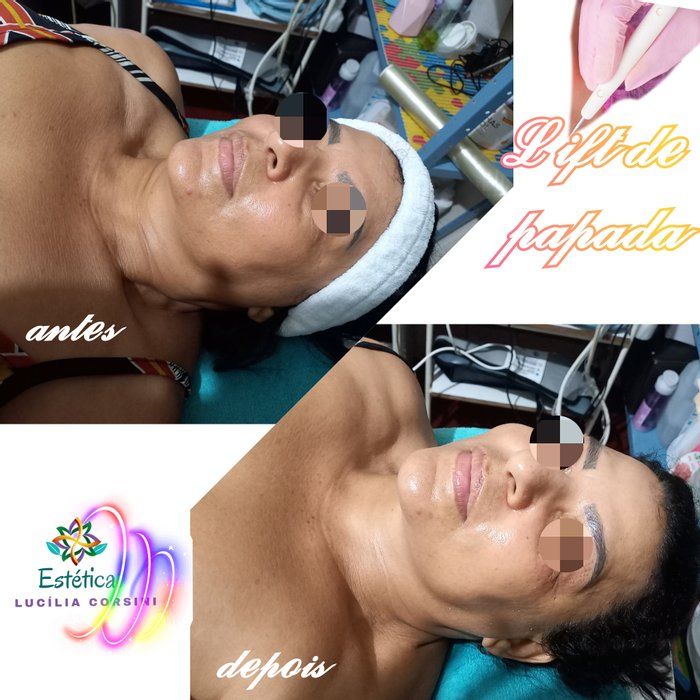 Estética       Lucília Corsini - beleza & estética - Jato de Plasma 