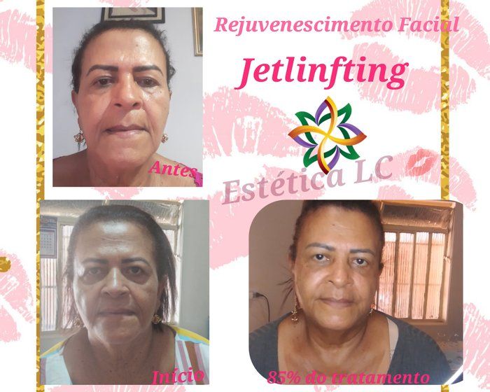 Estética       Lucília Corsini - beleza & estética - Jato de Plasma