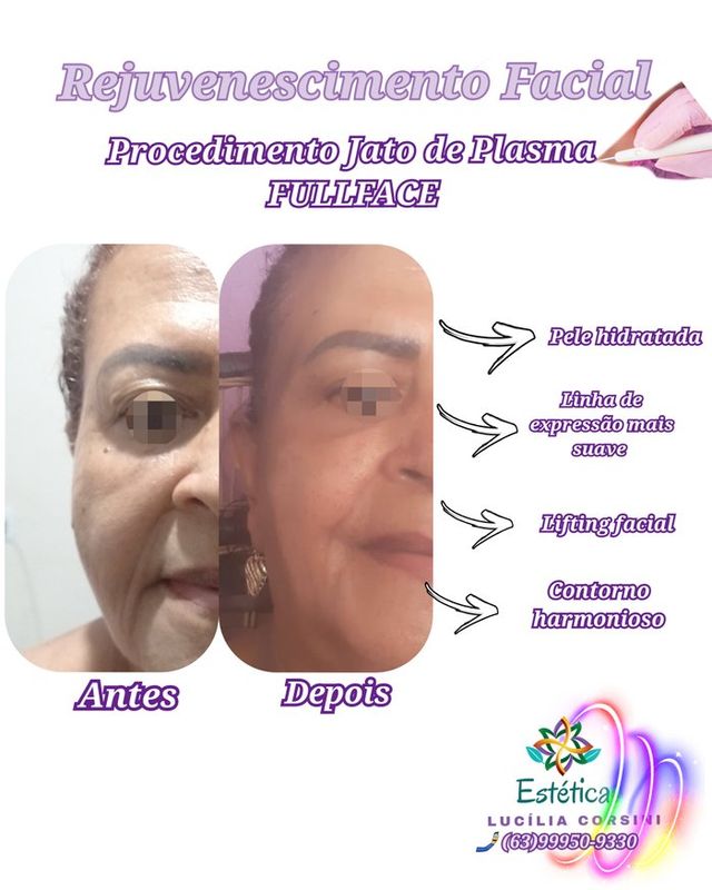 Estética       Lucília Corsini - beleza & estética - Jato de Plasma 