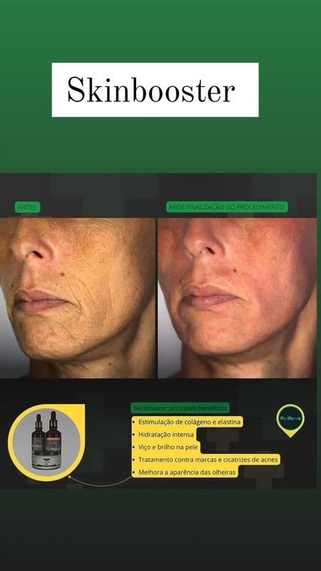 Janaina Patrício - beleza & estética - Microagulhamento Skin booster