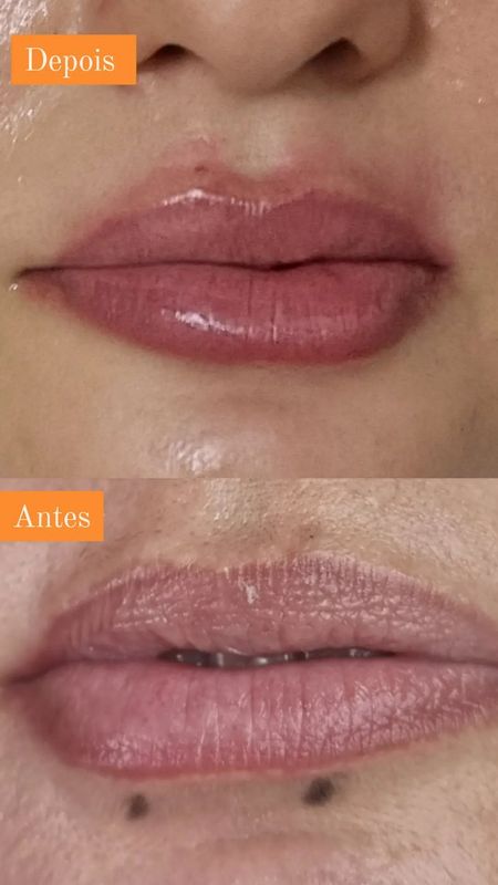 Janaina Patrício - beleza & estética - Preenchimento Labial 1ML