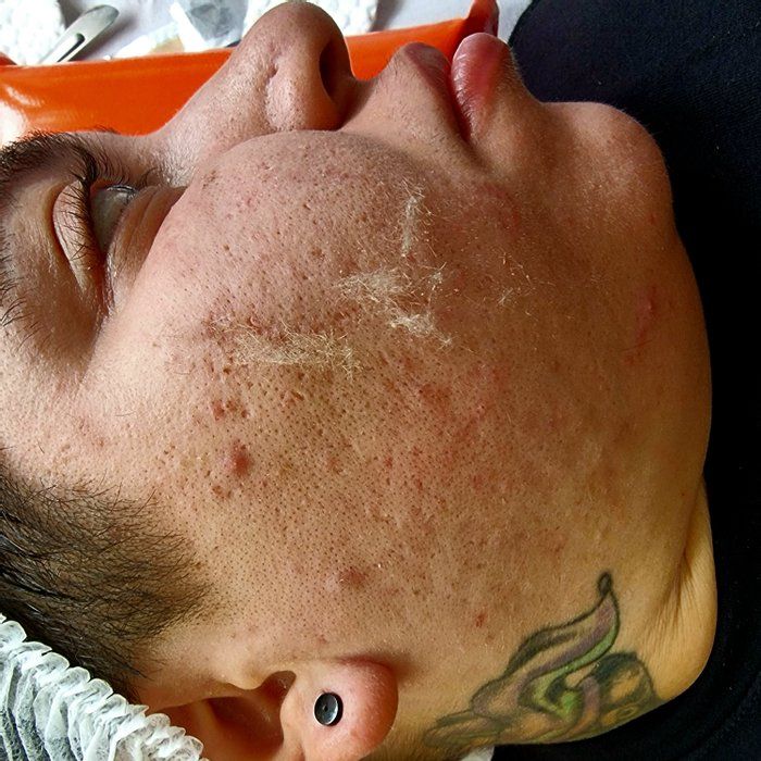 Janaina Patrício - beleza & estética - Dermaplaning 