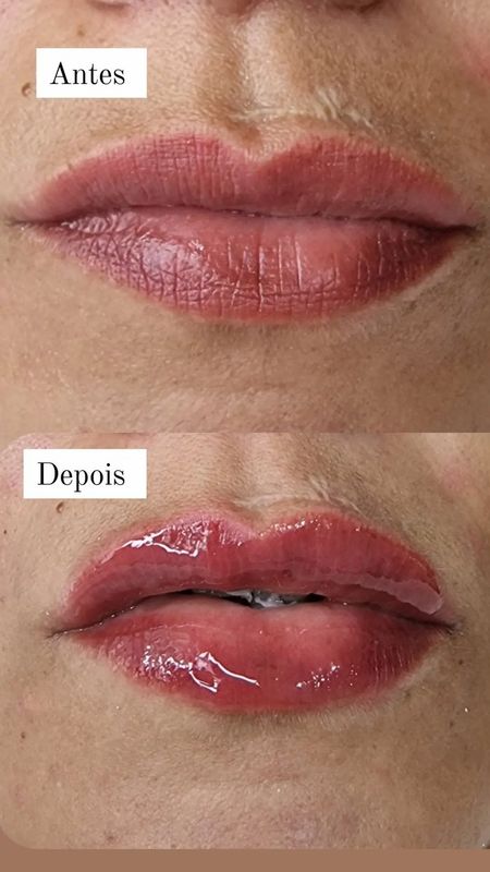 Janaina Patrício - beleza & estética - skinbooster like labial