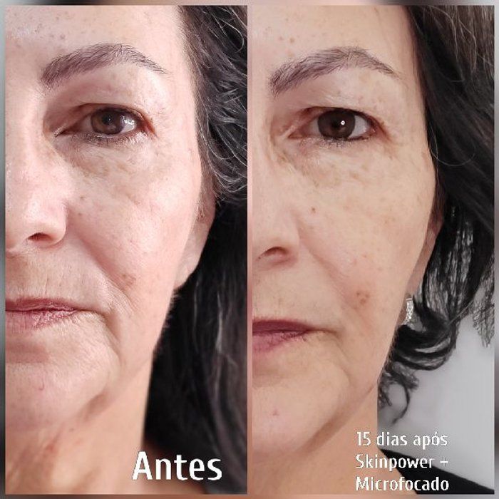 Ela por Elas Belezaria  - beleza & estética - Ultrassom Microfocado