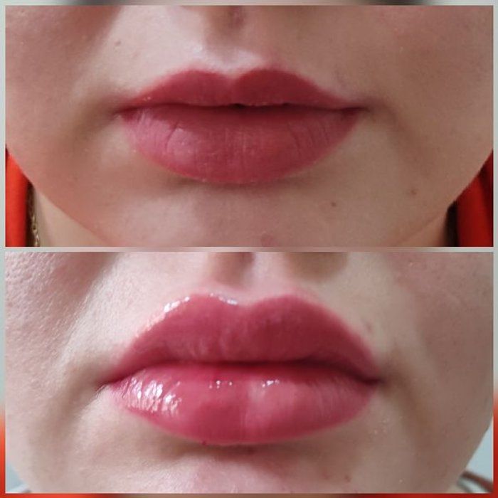 Ela por Elas Belezaria  - beleza & estética - Preenchimento Labial Técnica Russian Lips
