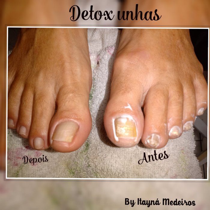 Itayná Medeiros - beleza & estética - Detox unhas