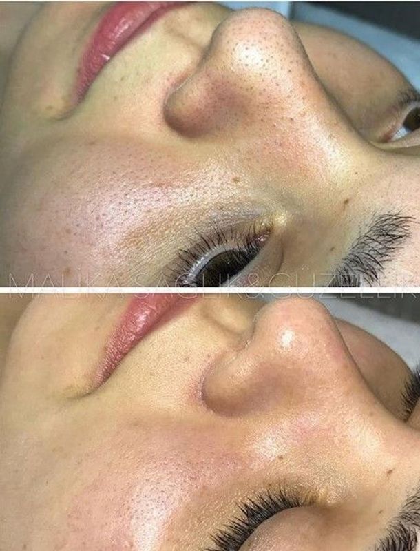 Janaína Rotelli Biomédica Esteta - beleza & estética - Limpeza de pele