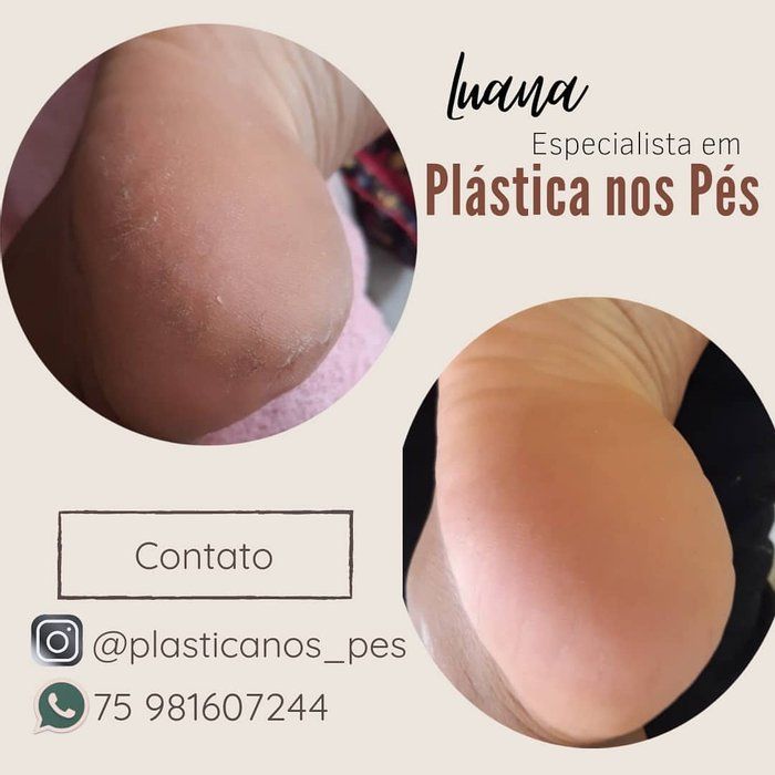 Luana Araújo - Especialista em Plástica dos Pés - Plástica dos Pés