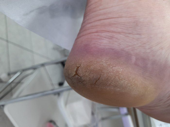 Clinica Pés de pérolas - Podologia, Estetica e bem-estar - Tratamento para fissuras