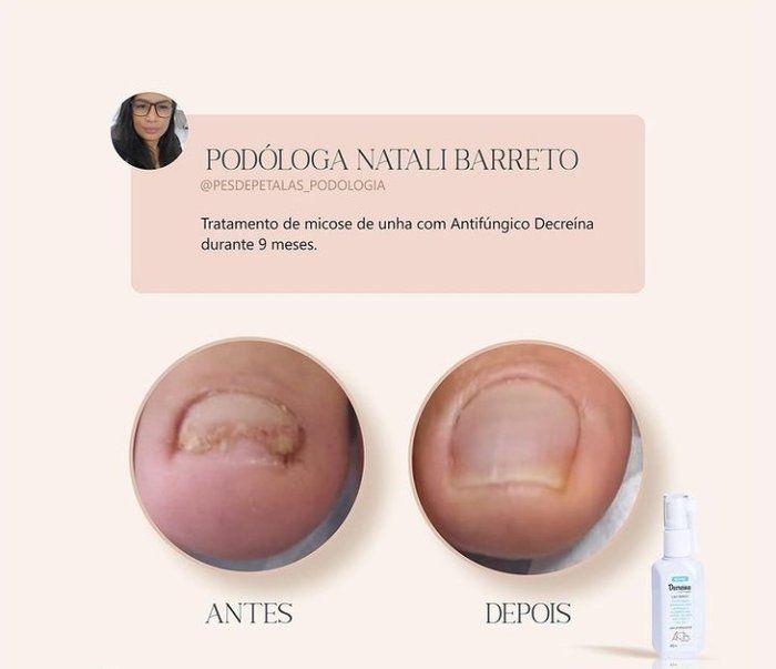 Clinica Pés de pérolas - Podologia, Estetica e bem-estar - Tratamento Micose