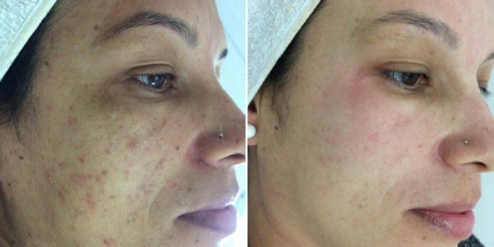 Espaço Una - beleza & estética - Limpeza de pele