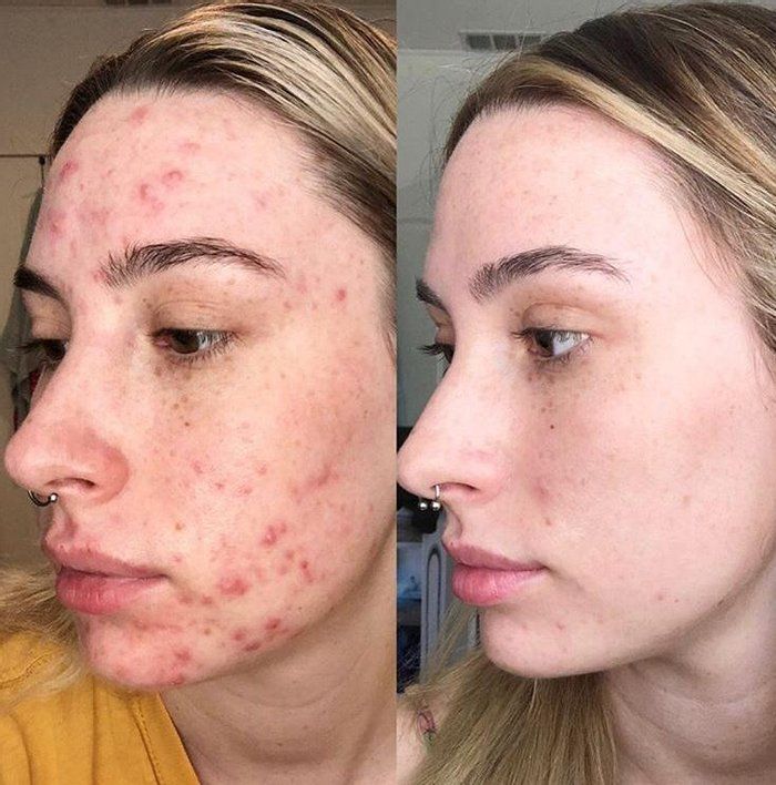 Espaço Una - beleza & estética - Peeling todos os tipos de pele