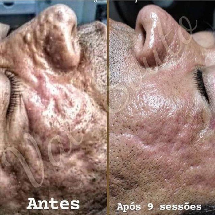 Espaço Una - beleza & estética - Microagulhamento
