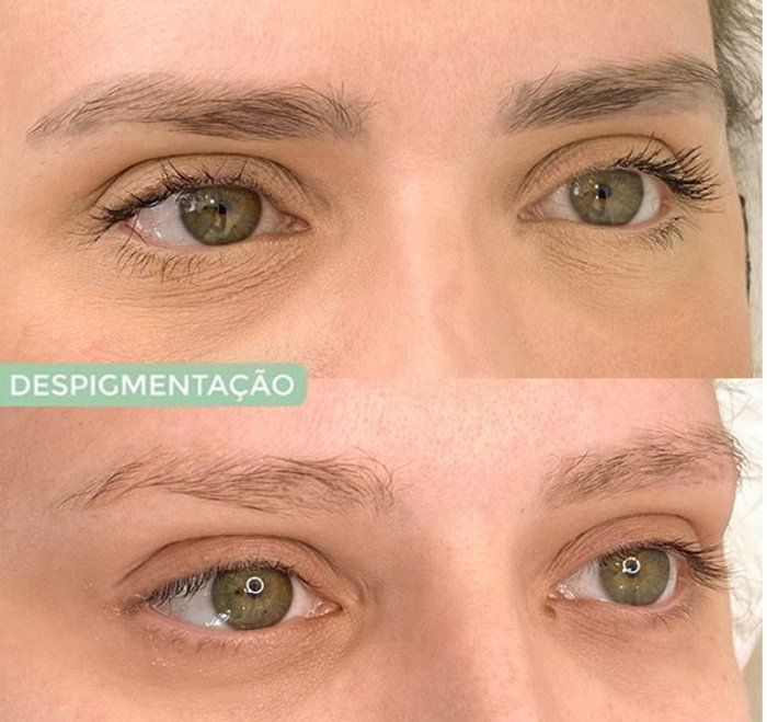 Studio Júlia Pimentel - Design de sobrancelhas, Micropigmentação, Lash Lifting, Brow lamination, Buço, Extensão de cilios, Dermaplaning, Hydra gloss, Despigmentação. - Despigmentação de Sobrancelhas