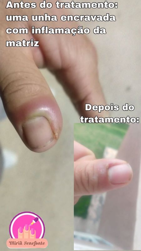 Miriã Senefonte - saúde & bem-estar - Unhas Encravadas