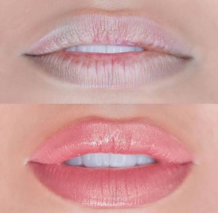 Dclinic Estética Avançada - beleza & estética - Hydra Gloss Lips