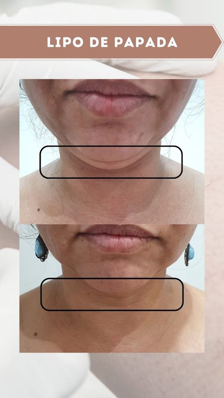 Juliana de Oliveira - Beauty Care - Estética Avançada - Lipo Enzimática da Papada