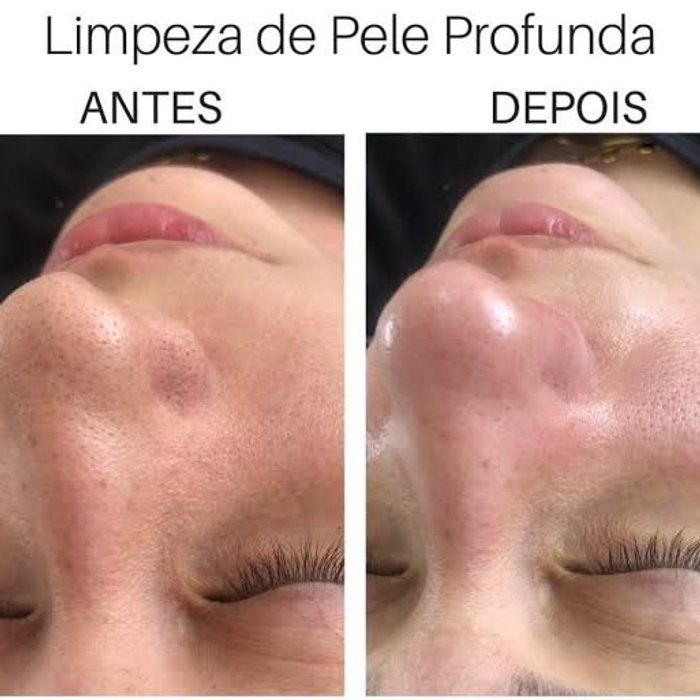 Heloisa Costa - beleza & estética - Limpeza de Pele Profunda