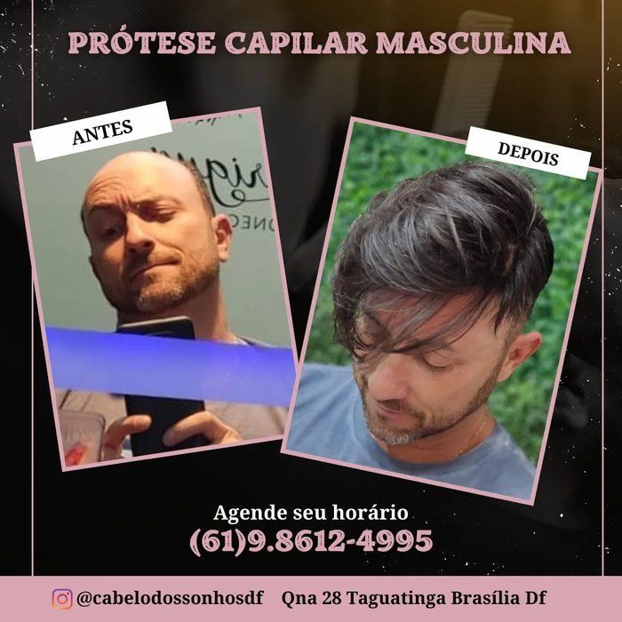 Cabelo dos Sonhos DF - Beleza & Estética - Prótese capilar masculina
