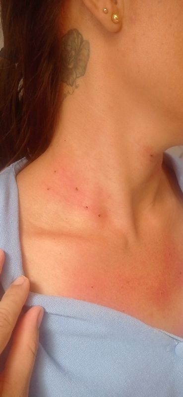 Rosângela Mendes - saúde e estética - Remoção de sinais