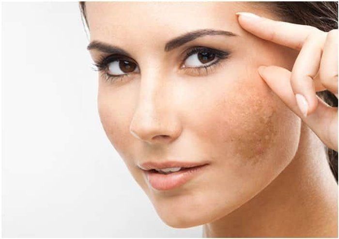 Nathalia Jales - Espaço beauty - Tratamento melasma off