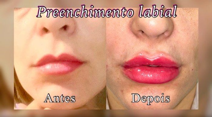 Dra Gabrielle Bieli - Harmonização Facial - harmonização facial