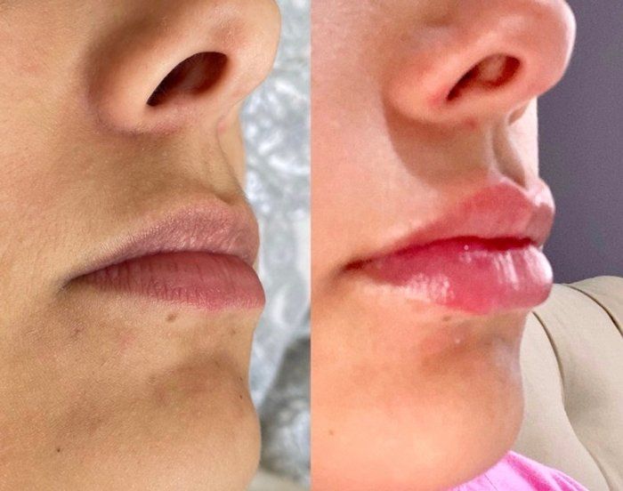 Dra Gabrielle Bieli - Harmonização Facial - preenchimento labial com ácido hialurônico