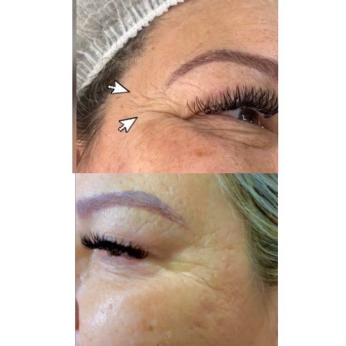 Dra Gabrielle Bieli - Harmonização Facial - botox pés de galinha