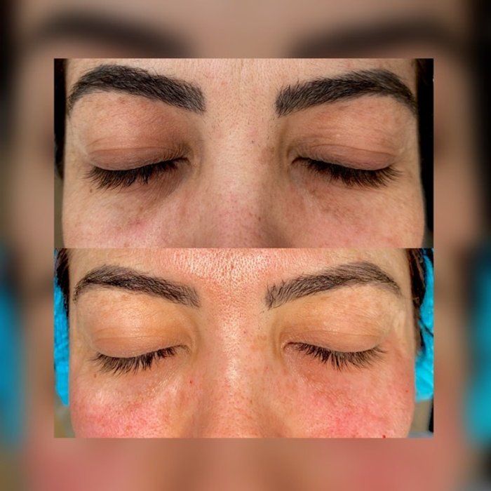 Dra Gabrielle Bieli - Harmonização Facial - preenchimento olheiras