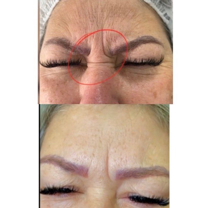 Dra Gabrielle Bieli - Harmonização Facial - botox glabela