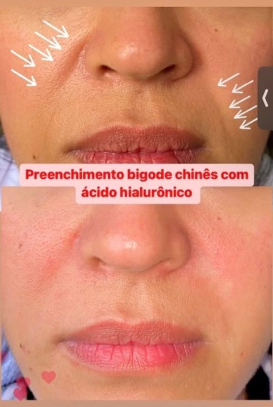 Dra Gabrielle Bieli - Harmonização Facial - preenchimento bigode chinês