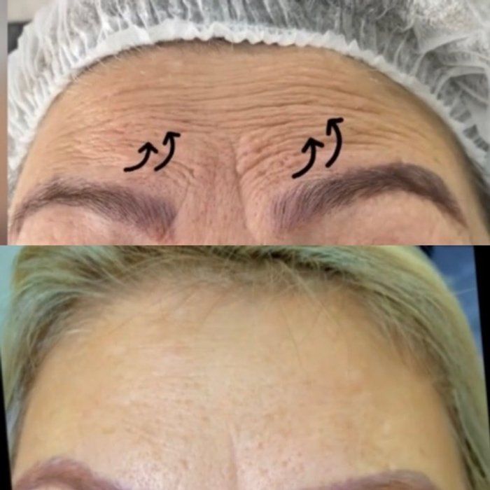Dra Gabrielle Bieli - Harmonização Facial - botox testa